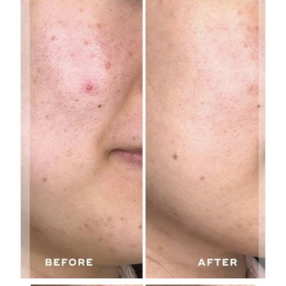 ACEOLOGY Detoxifying Treatment Mask - Picture 4 of 9